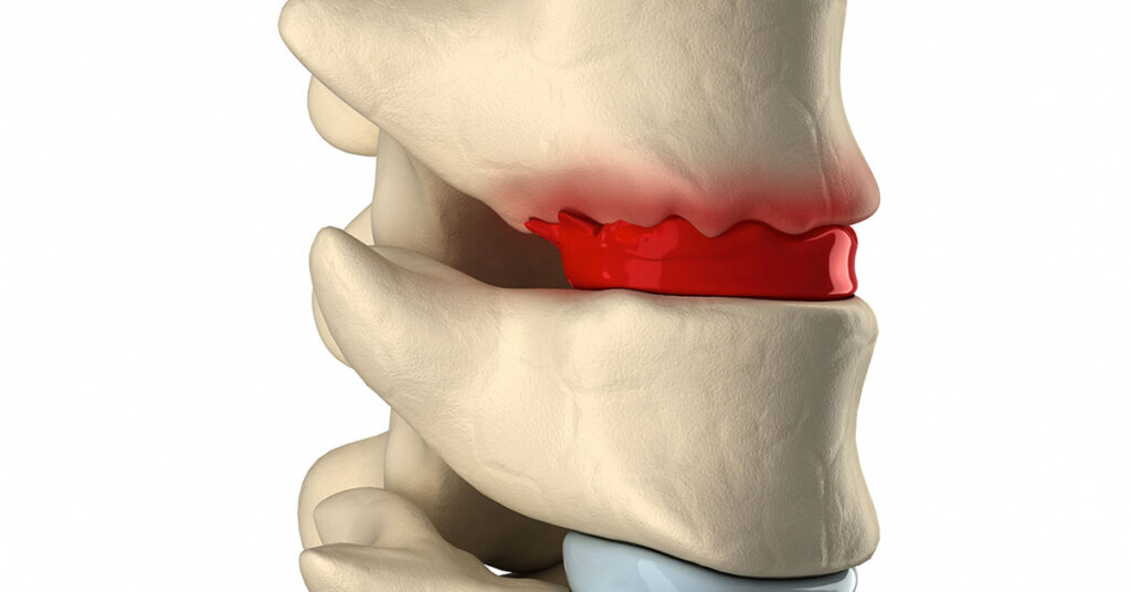 Degenerative Disc Disease | Mumbai Speciality Clinic