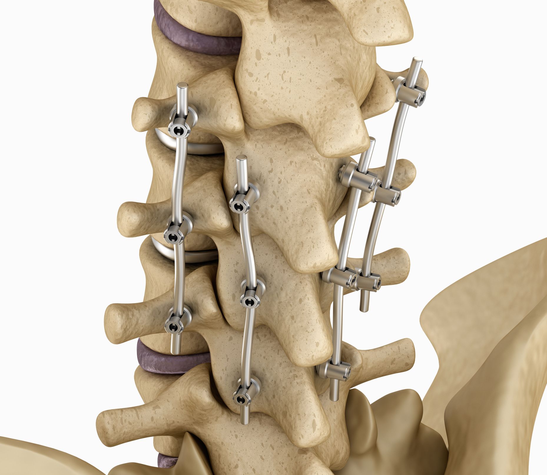 Spinal Fusion | Mumbai Speciality Clinic