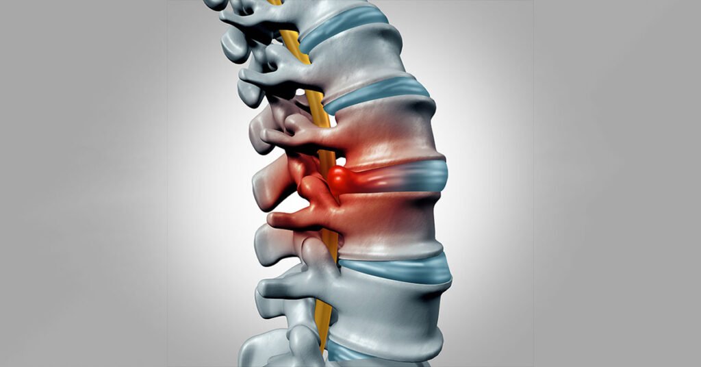 Spinal stenosis - Symptoms and causes | Mumbai Speciality Clinic