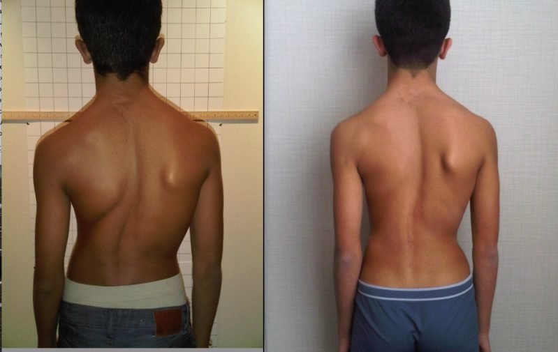 Scoliosis - Symptoms and causes | Mumbai Speciality Clinic