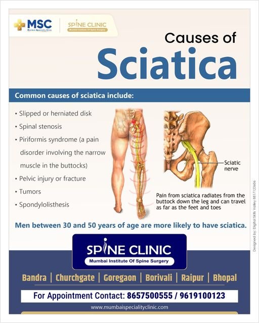 Sciatica, sciatica symptoms, sciatic nerve